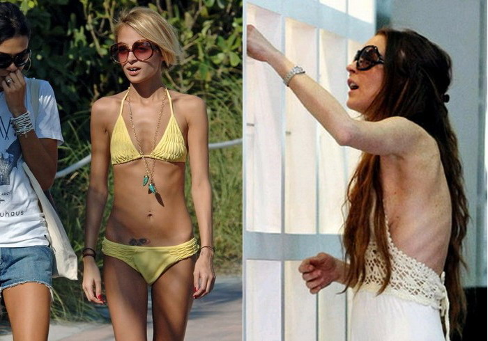 Анорексия знаменитости фото до и после