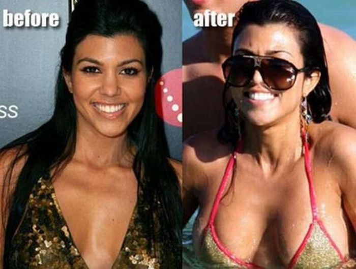 Фото груди до операции и после фото