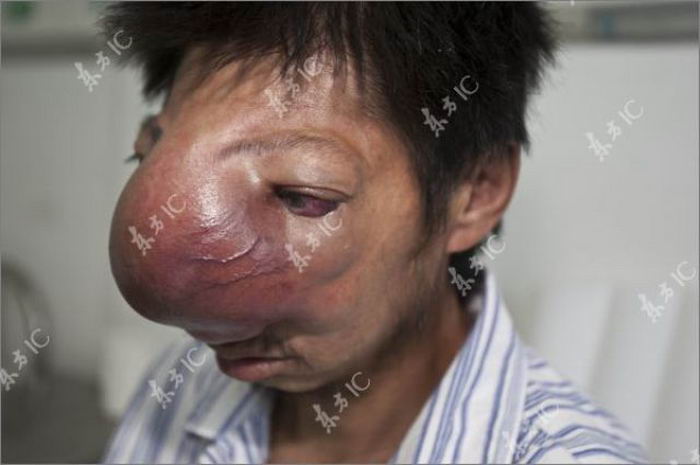Мужчина со страшной болезнью носа