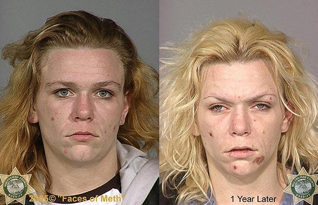 Фотографии наркоманов до и после