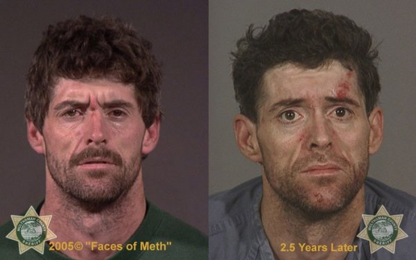 Фотографии наркоманов до и после