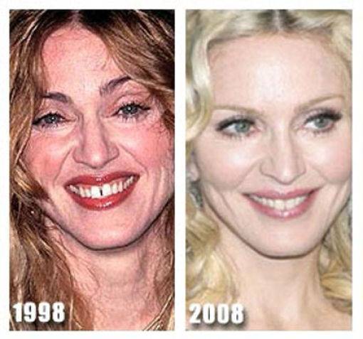 Знаменитости до и после пластической хирургии