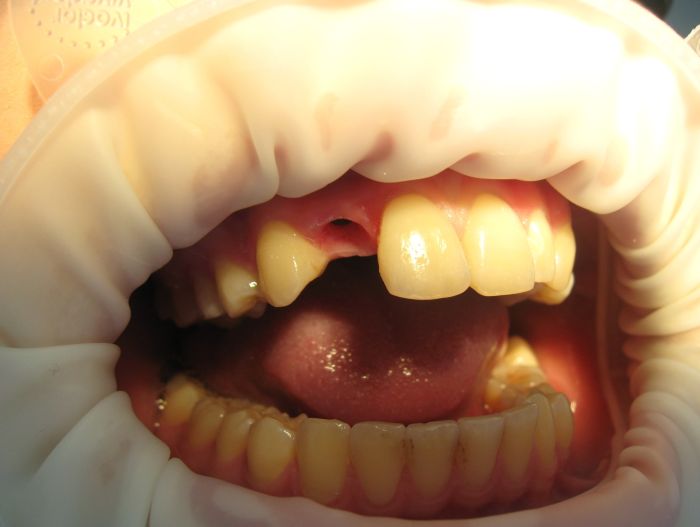 Как устанавливают зубные импланты (3 фото)